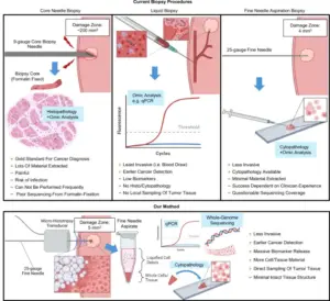 Revolutionizing Cancer Diagnostics: The Breakthrough of Shock-Scattering Micro-Histotripsy-Aided Fine Needle Aspiration
