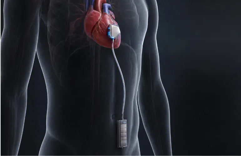 Revolutionizing Life-Saving Technologies: ITEN Spearheads Solid-State Battery Breakthrough for Class III Implantable Medical Devices